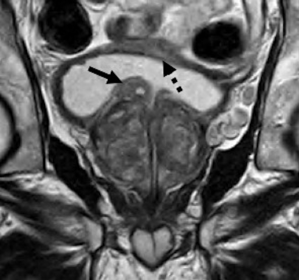 benign prostatic hyperplasia mri radiographics