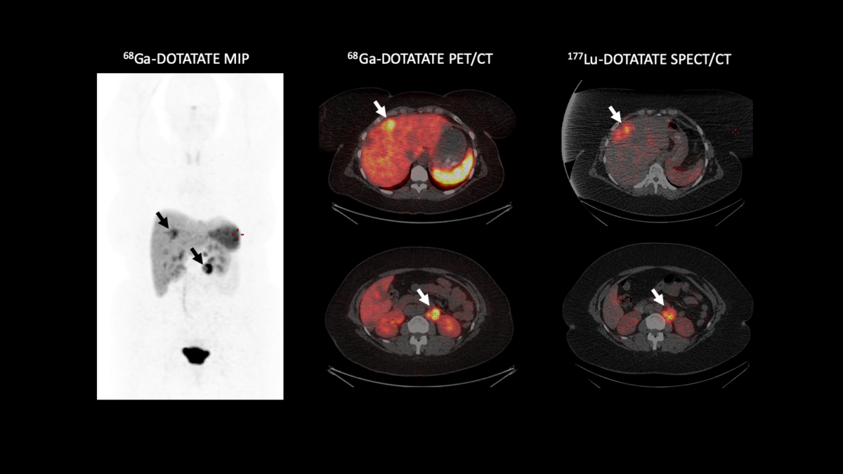 Hybrid imaging gives boost to diagnosis and treatment in cases of neuroendocrine tumours